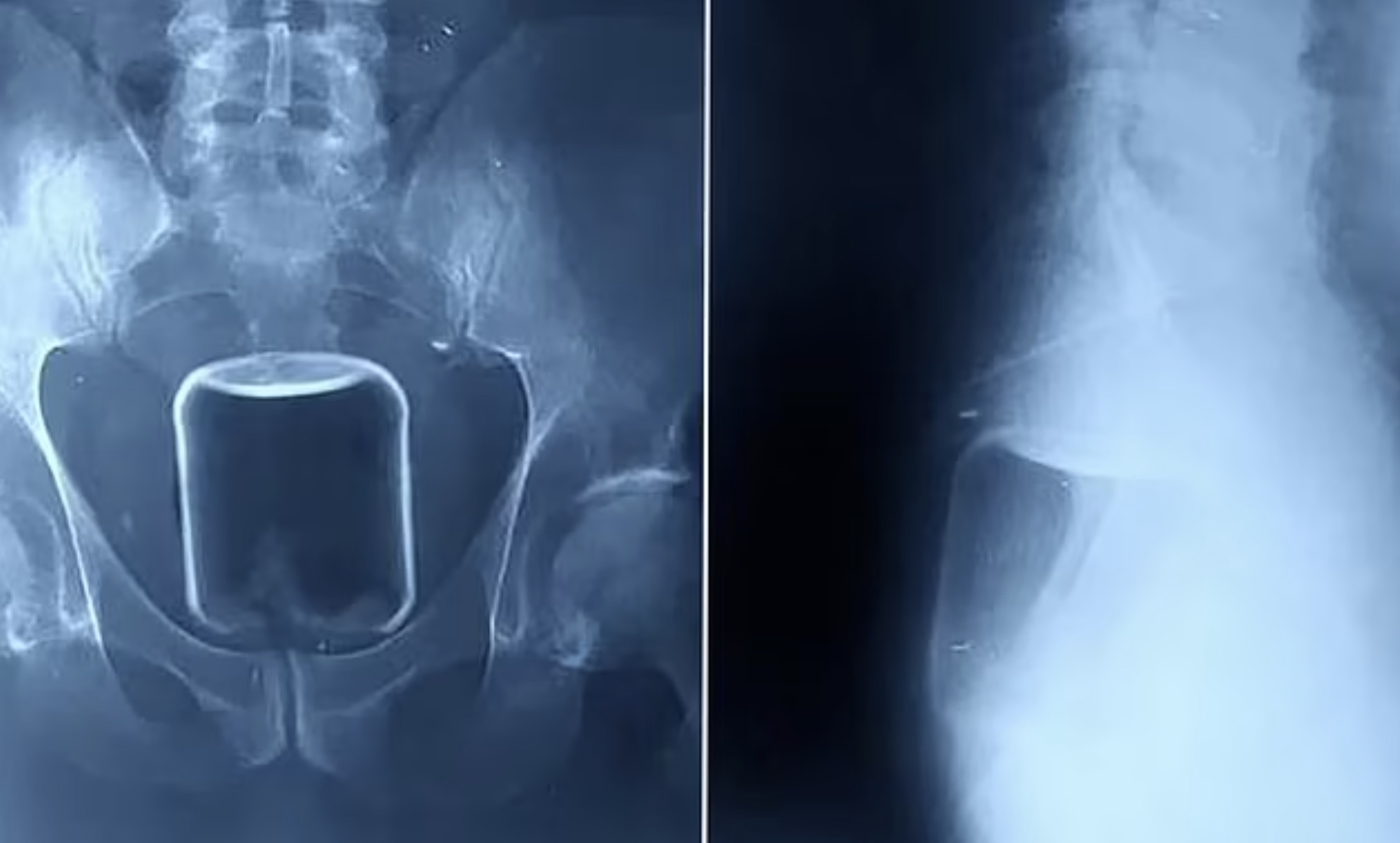 jar in ass xray